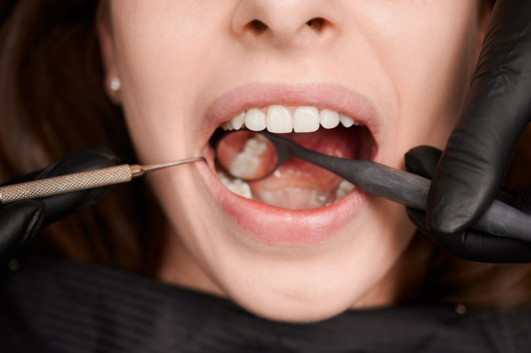 Understanding Tooth Decay: Prevention and Treatment Strategies